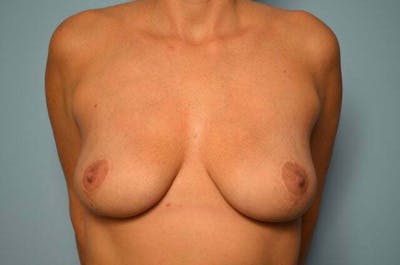 Breast Implant Removal Before & After Gallery - Patient 105880 - Image 2