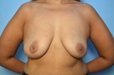 Breast Implant Removal Before & After Gallery - Patient 965395 - Image 2