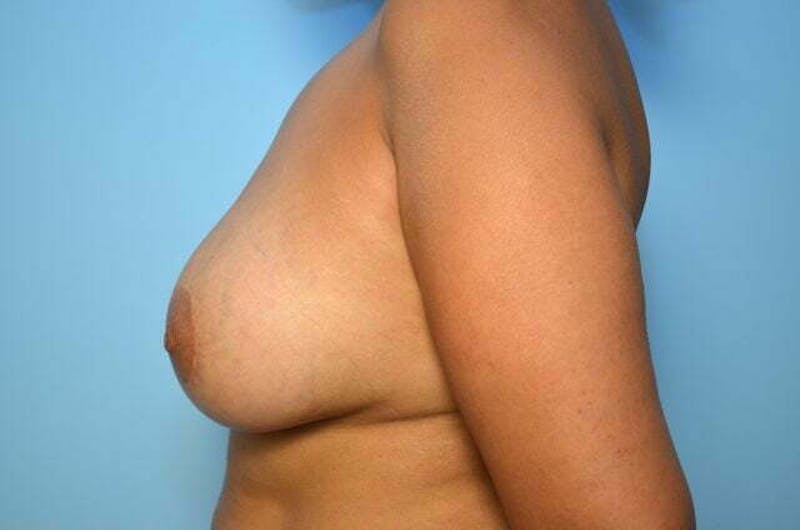 Breast Implant Removal Before & After Gallery - Patient 965395 - Image 9