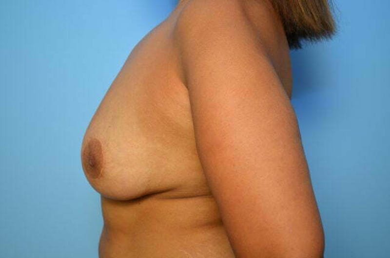 Breast Implant Removal Before & After Gallery - Patient 965395 - Image 10