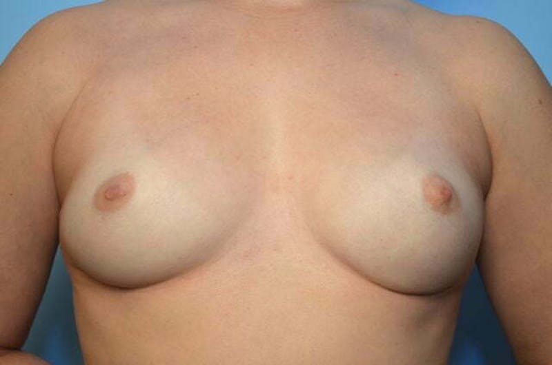 Breast Implant Removal Before & After Gallery - Patient 421957 - Image 2