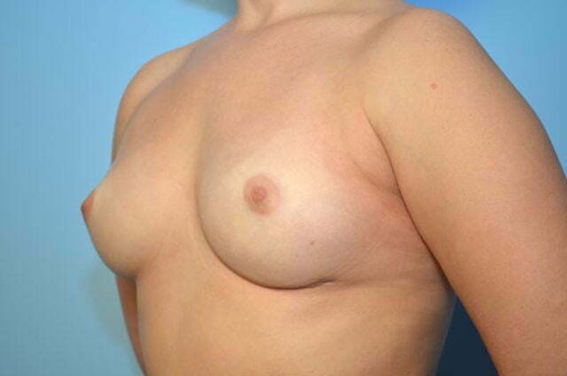 Breast Implant Removal Before & After Gallery - Patient 421957 - Image 8