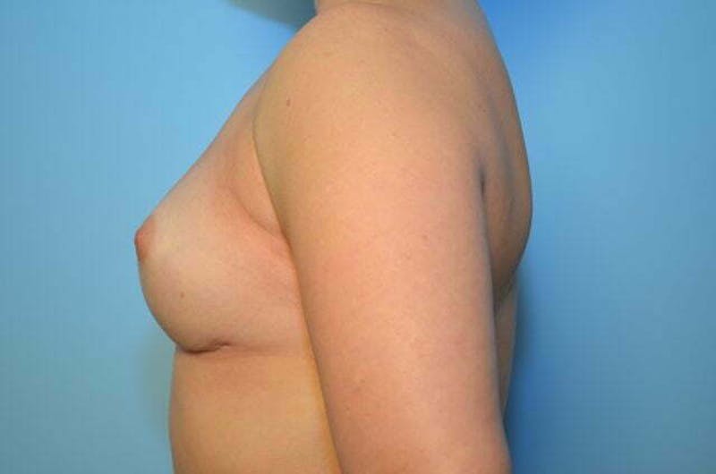 Breast Implant Removal Before & After Gallery - Patient 421957 - Image 10