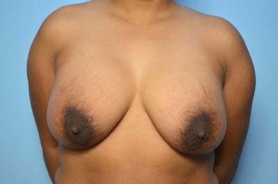 Breast Implant Removal Before & After Gallery - Patient 298487 - Image 1