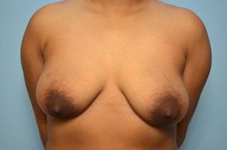 Breast Implant Removal Before & After Gallery - Patient 298487 - Image 2