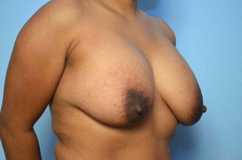 Breast Implant Removal Before & After Gallery - Patient 298487 - Image 3