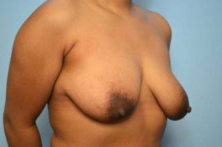 Breast Implant Removal Before & After Gallery - Patient 298487 - Image 4