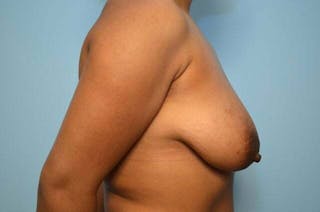 Breast Implant Removal Before & After Gallery - Patient 298487 - Image 6