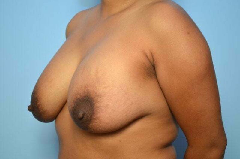 Breast Implant Removal Before & After Gallery - Patient 298487 - Image 7