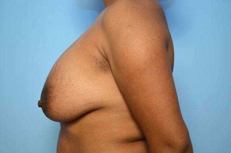 Breast Implant Removal Before & After Gallery - Patient 298487 - Image 9