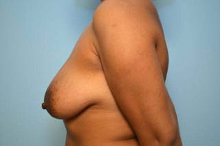 Breast Implant Removal Before & After Gallery - Patient 298487 - Image 10
