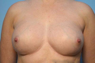 Breast Implant Removal Before & After Gallery - Patient 150122 - Image 1