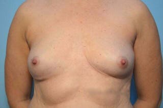 Breast Implant Removal Before & After Gallery - Patient 150122 - Image 2