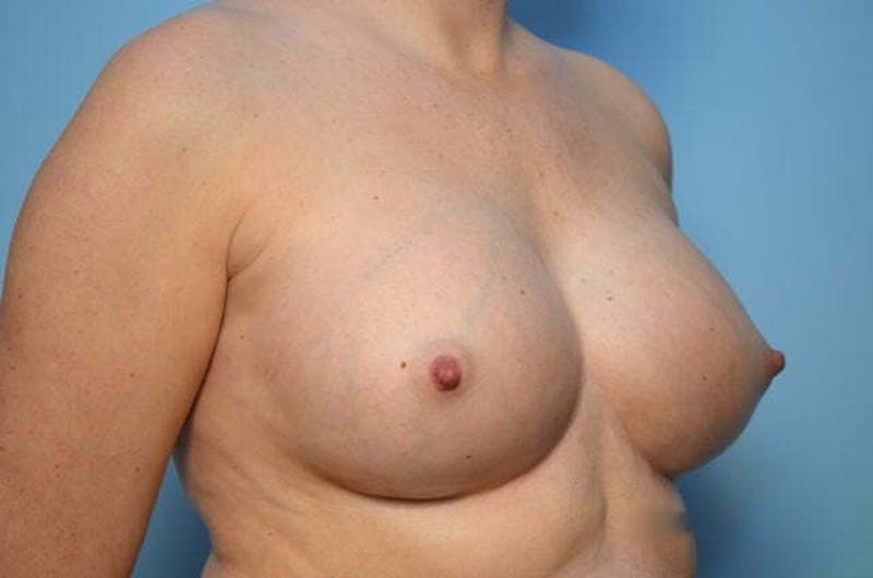 Breast Implant Removal Before & After Gallery - Patient 150122 - Image 3
