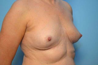 Breast Implant Removal Before & After Gallery - Patient 150122 - Image 4