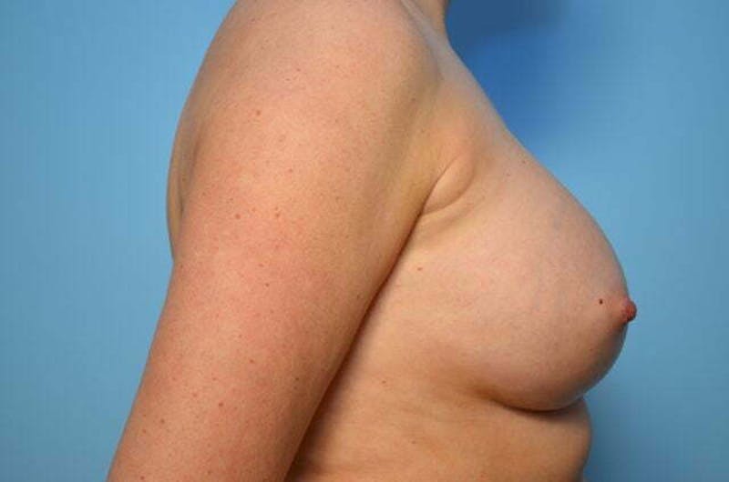 Breast Implant Removal Before & After Gallery - Patient 150122 - Image 5