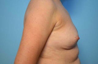 Breast Implant Removal Before & After Gallery - Patient 150122 - Image 6