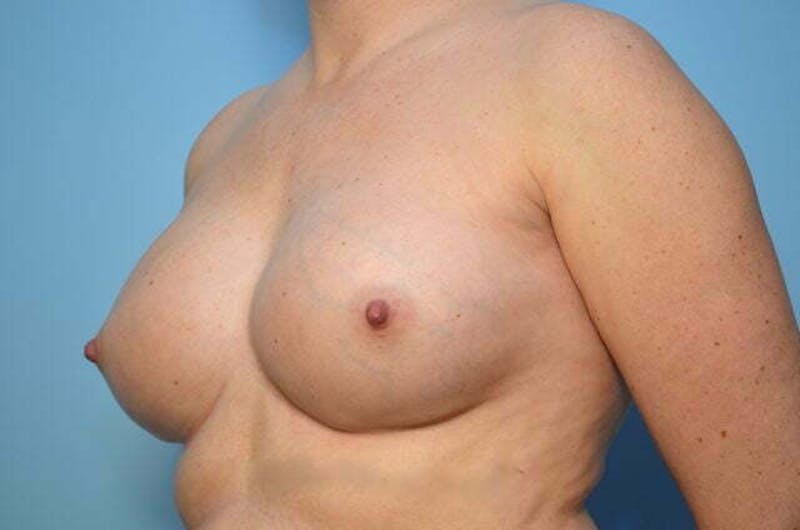 Breast Implant Removal Before & After Gallery - Patient 150122 - Image 7