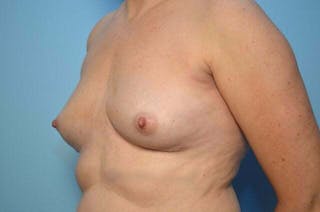 Breast Implant Removal Before & After Gallery - Patient 150122 - Image 8