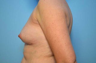 Breast Implant Removal Before & After Gallery - Patient 150122 - Image 10