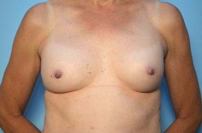 Breast Implant Removal Before & After Gallery - Patient 424472 - Image 1