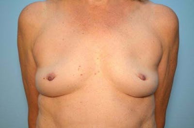 Breast Implant Removal Before & After Gallery - Patient 424472 - Image 2