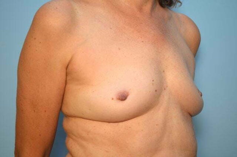 Breast Implant Removal Before & After Gallery - Patient 424472 - Image 4