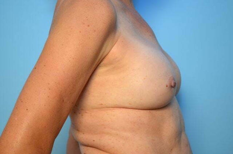 Breast Implant Removal Before & After Gallery - Patient 424472 - Image 5