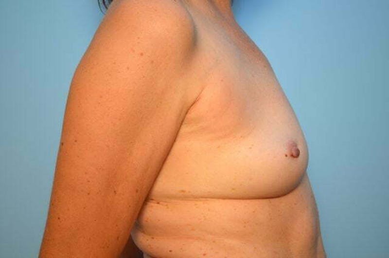 Breast Implant Removal Before & After Gallery - Patient 424472 - Image 6