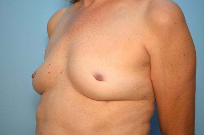 Breast Implant Removal Before & After Gallery - Patient 424472 - Image 8