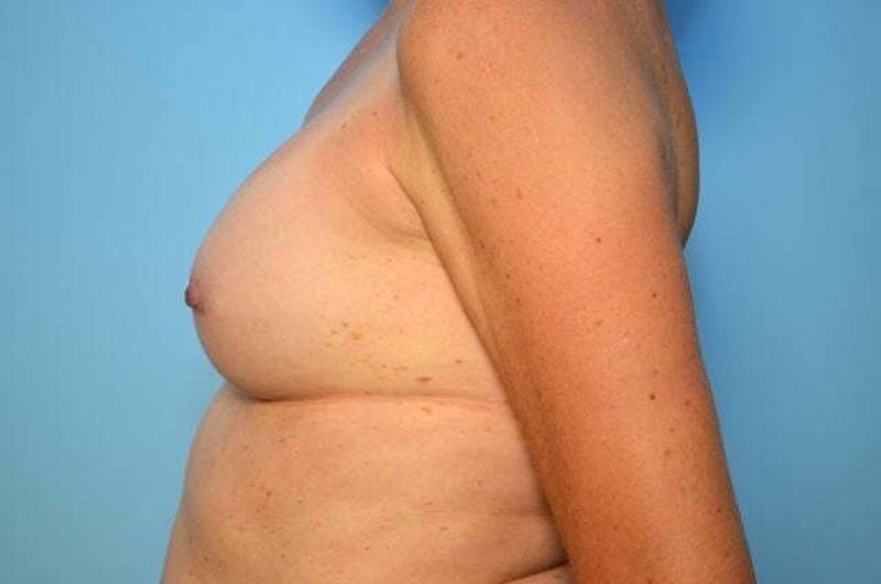 Breast Implant Removal Before & After Gallery - Patient 424472 - Image 9