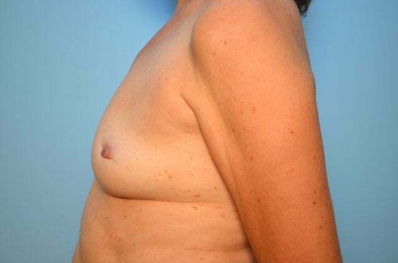 Breast Implant Removal Before & After Gallery - Patient 424472 - Image 10