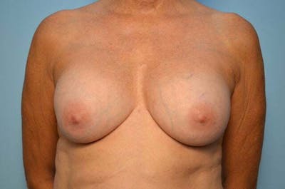 Breast Implant Removal Before & After Gallery - Patient 409122 - Image 1
