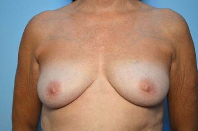 Breast Implant Removal Before & After Gallery - Patient 409122 - Image 2