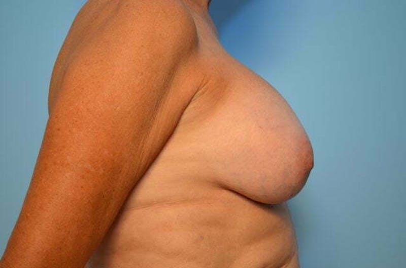 Breast Implant Removal Before & After Gallery - Patient 409122 - Image 5