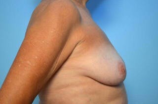 Breast Implant Removal Before & After Gallery - Patient 409122 - Image 6