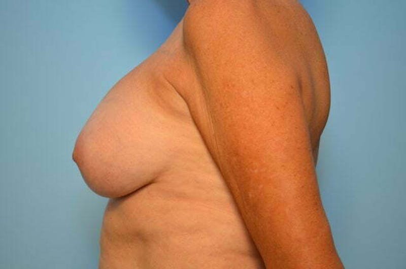 Breast Implant Removal Before & After Gallery - Patient 409122 - Image 9