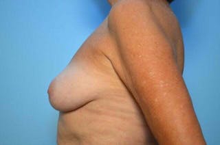 Breast Implant Removal Before & After Gallery - Patient 409122 - Image 10