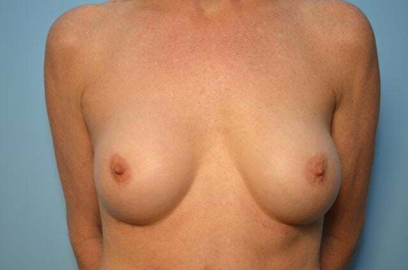 Breast Implant Removal Before & After Gallery - Patient 404231 - Image 1