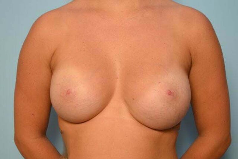 Breast Implant Removal Before & After Gallery - Patient 310520 - Image 1