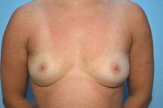 Breast Implant Removal Before & After Gallery - Patient 310520 - Image 2