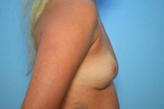 Breast Implant Removal Before & After Gallery - Patient 310520 - Image 6