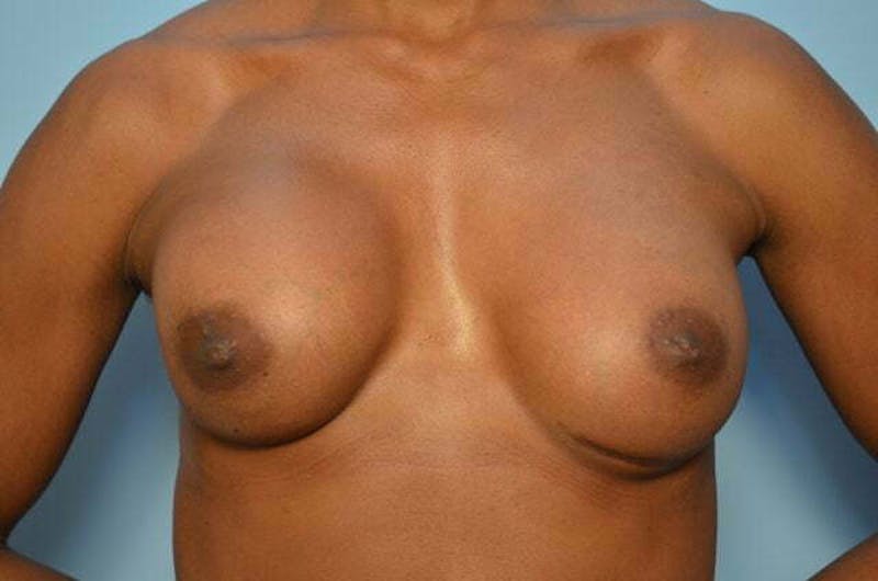 Breast Implant Removal Before & After Gallery - Patient 263511 - Image 1