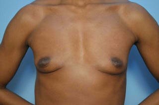 Breast Implant Removal Before & After Gallery - Patient 263511 - Image 2