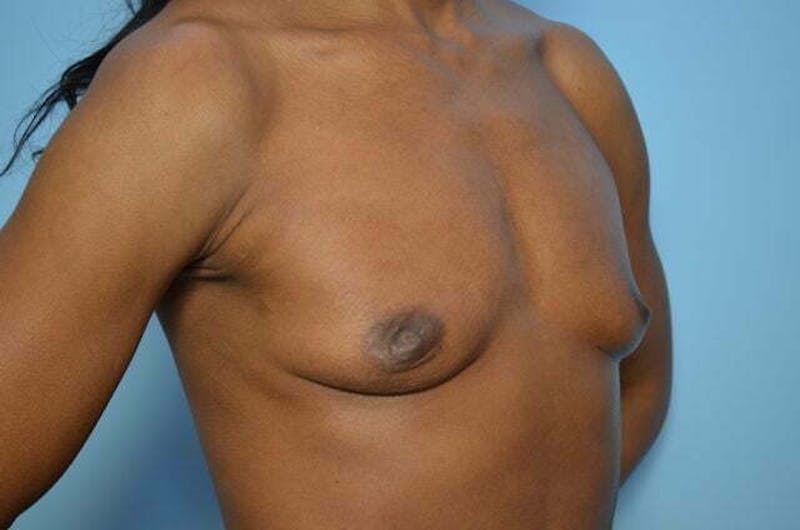 Breast Implant Removal Before & After Gallery - Patient 263511 - Image 4