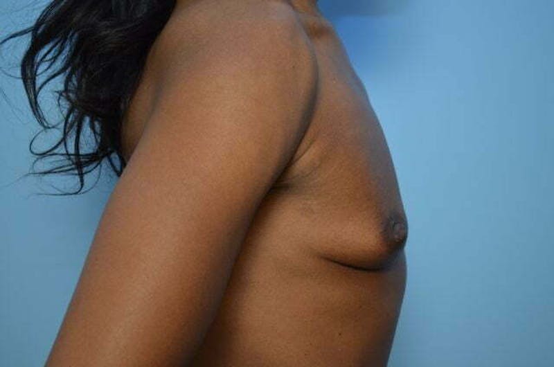 Breast Implant Removal Before & After Gallery - Patient 263511 - Image 6