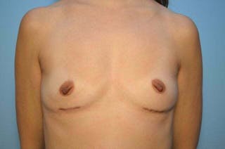 Breast Implant Removal Before & After Gallery - Patient 218743 - Image 2