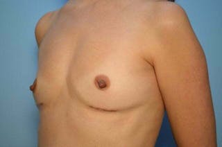 Breast Implant Removal Before & After Gallery - Patient 218743 - Image 8