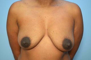 Breast Implant Removal Before & After Gallery - Patient 327747 - Image 2