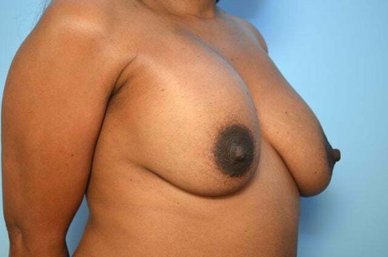 Breast Implant Removal Before & After Gallery - Patient 327747 - Image 3